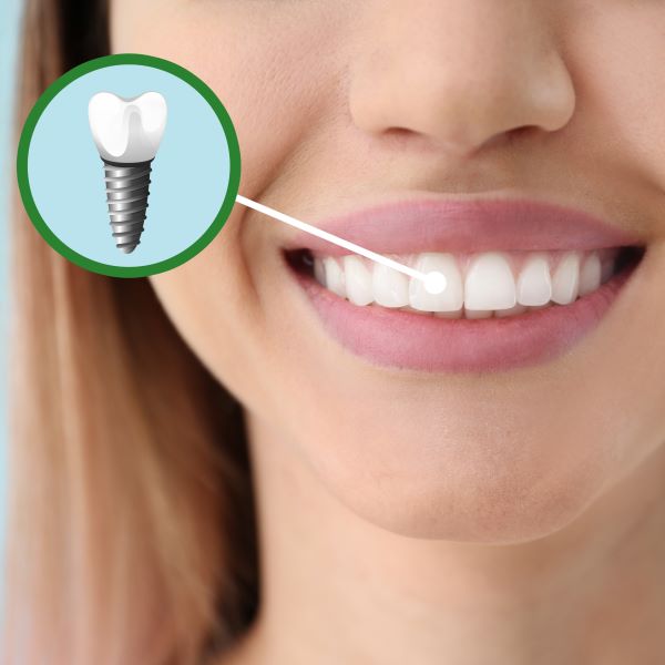 dental-implant
